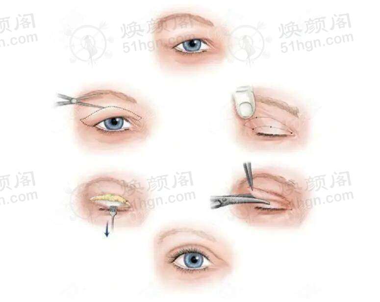 广州中家医家庭医生医疗美容门诊部的黄金微针优势多