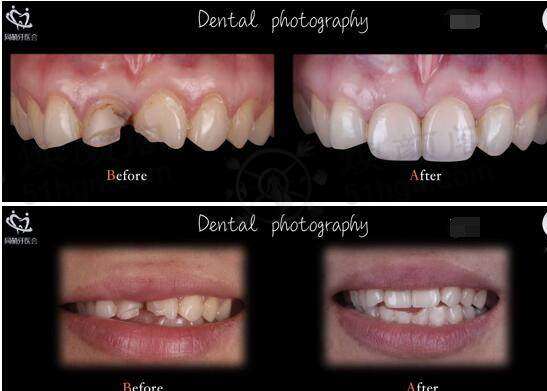 我在南京美奥洗牙，多年牙石和牙龈出血问题终于解决啦！ 