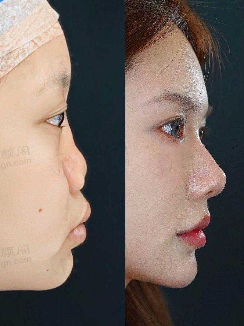 我在韩国elev皮肤科做分层抗衰，法令纹苹果肌下垂全改善！ 